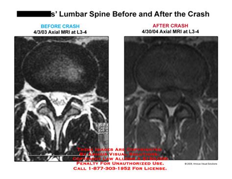 Amicus Illustration Of Amicus Radiology Axial L Normal Disc