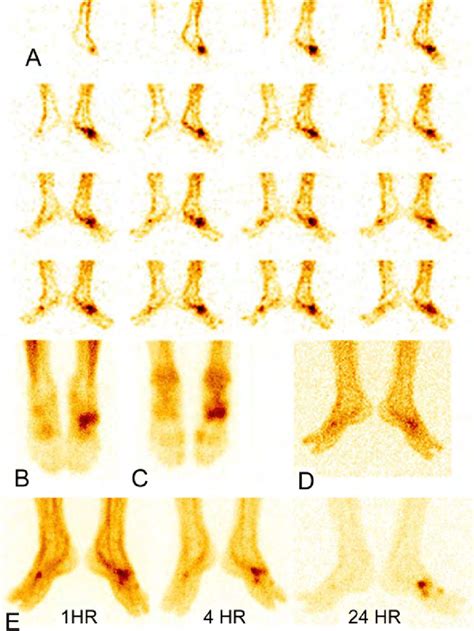 Three Phase Bone Scintigraphy Of The Feet With 99mtc Mdp Showing