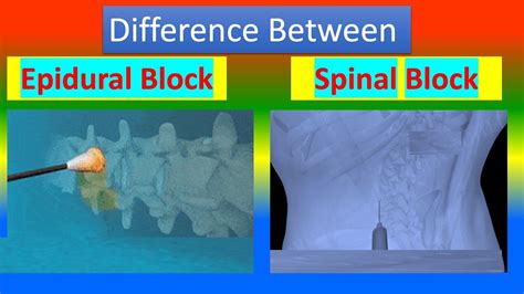 Differences Between An Epidural Block And A Spinal Block YouTube