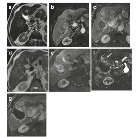 Hepatic Focal Lesion After Tace A T Wi Shows A Well Defined Cystic