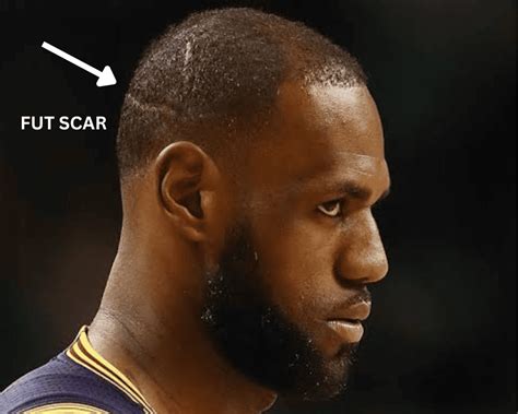 Lebron James Hair Plugs