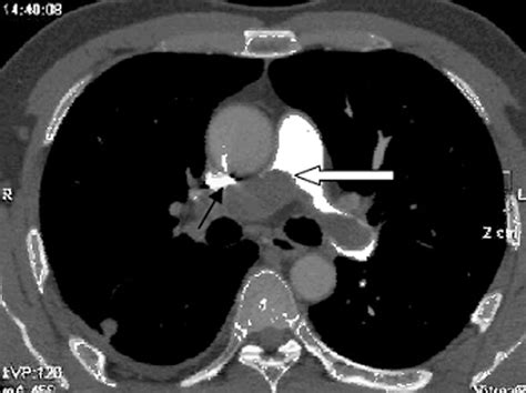 Pulmonary Artery Computed Tomography Angiography Axial View The Lumen