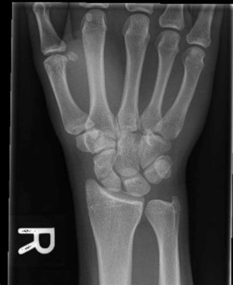 Xrays Of Broken Wrist