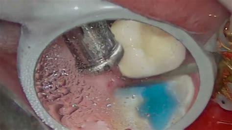 Maxillary Second Molar Crown Preparation Under Magnification With Indirect Vision Youtube