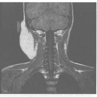 MRI T 2 Weighted Spin Echo Sequence Axial Plane High Signal