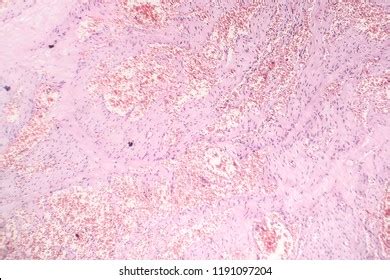 Capillary Hemangioma Light Micrograph Photo Under Stock Photo