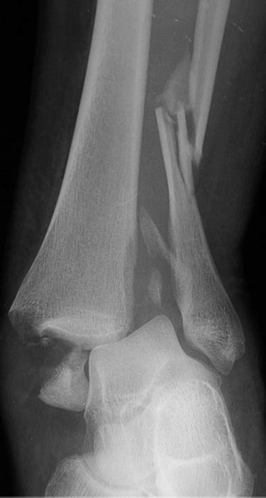 Ankle Fracture — Tonya An Md