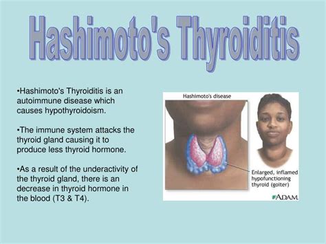 Ppt Thyroid Disease Powerpoint Presentation Id4429966