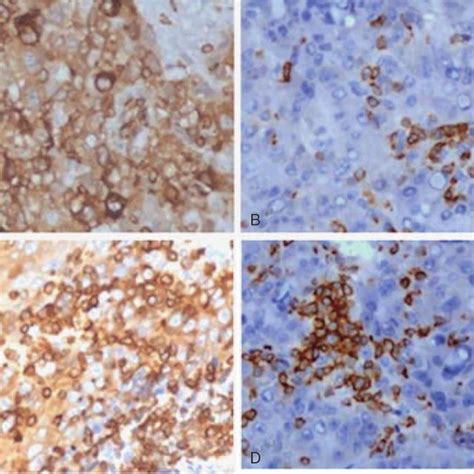 Immunohistochemical Analysis Of Ezrin Expression In Hcc Before And