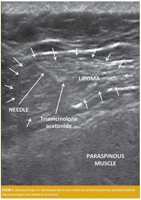 Lipoma Ultrasound Treatment - Infoupdate.org