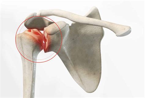 D Finition Sympt Mes Et Diagnostic De L Arthrose De L Paule Dr Paillard