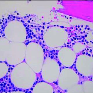 Flow Cytometry The Blasts Are Positive For Cd And Negative For Cd