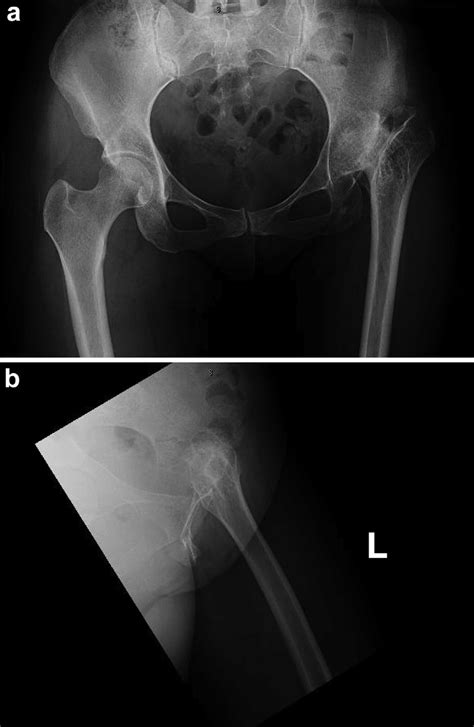 A And B Case Preoperative Anteroposterior Ap Pelvis And Frog Leg