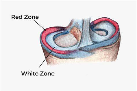 All About Meniscus Tears Advanced Ortho And Spine