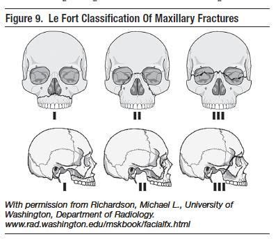 Figure Le Fort Classification Of Maxillary Fractures Emergency