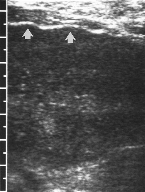 Wk 2 Liver Pathology Nodular Liver Surface Abdomen Ultrasound