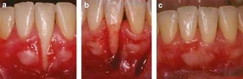 Coverage Of A Miller Class II Recession Using A Lateral Sliding Flap A