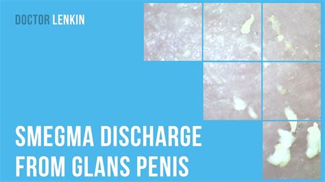 👉 Smegma Discharge From Glans Penis Youtube