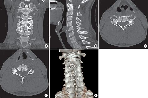 Traumatic Cervical Cord Transection Without Facet Dislocations A