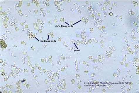 red and white blood cells, and yeast in urine sediment | Medical ...