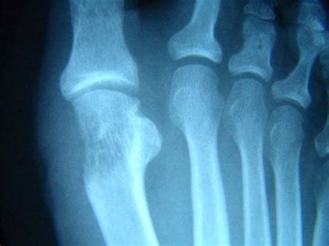 Tibial Sesamoid Fracture The Foot And Ankle Online Journal
