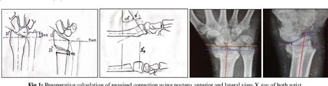 Figure From A Study On Functional And Radiological Outcome After