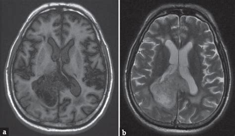 Advanced Magnetic Resonance Imaging Of Glioblastoma Multiforme