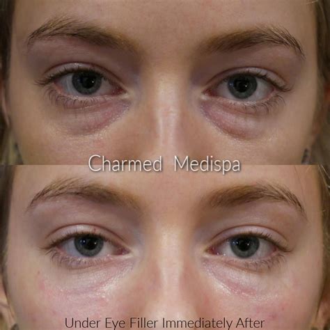 List 96 Pictures Under Eye Fillers Before And After Pictures Excellent