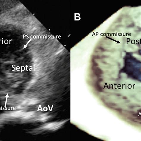 Visualization of the tricuspid valve with 2- and 3-dimensional ...