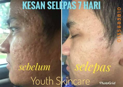 Produk Untuk Parut Jerawat Berlubang Vitamin Ummi Zara Pakar