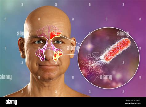 Pseudomonas Aeruginosa Bacteria As A Cause Of Sinusitis Computer