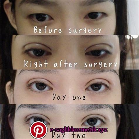 My Double Eyelid Surgery Experience My Double Eyelid Surgery Experience