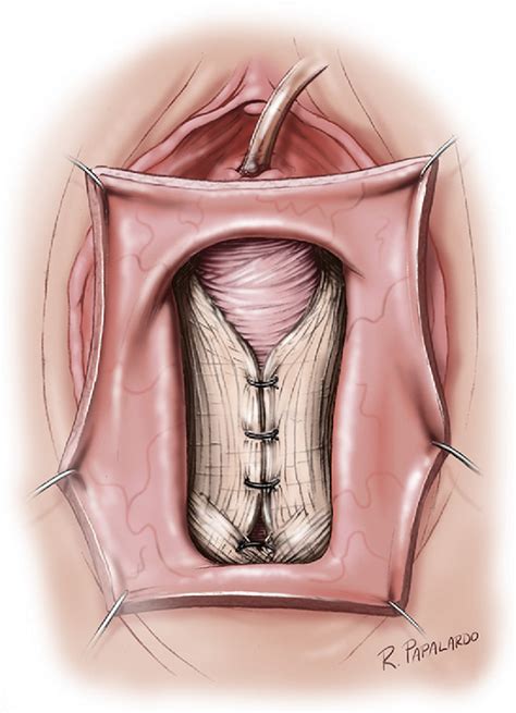 Figure 7 From Evaluation And Management Of Pelvic Organ Prolapse In Elderly Women Semantic