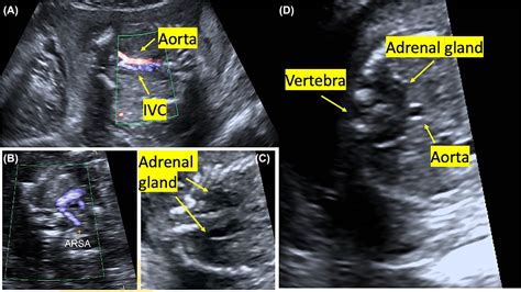 A New Sonographic Marker In The Diagnosis Of Prenatal Bilateral Renal Agenesis Segmental