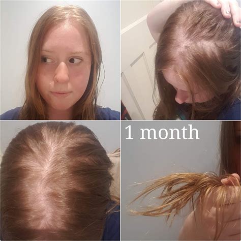 Hair Loss Hair Recovery A Journey The Ecological