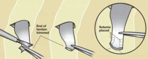 Distal Biceps Tear - Jackson Orthopaedics Jackson Orthopaedics