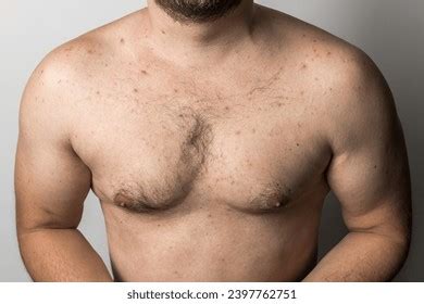 Naked Man Red Pimples On His Stock Photo 2397762751 Shutterstock