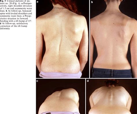 Clinical Pictures Of Patient No Fig A Preoperatively Right