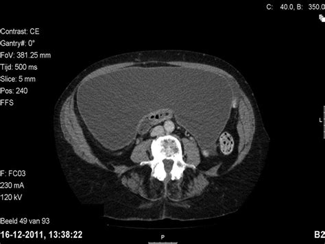 Can Benign Ovarian Cysts Elevate CA-125 Levels? – Coach M Morris