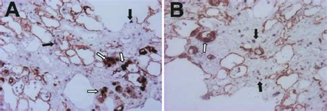 Effect Of Zd On Epithelial Cell Proliferation In Bleomycin Induced