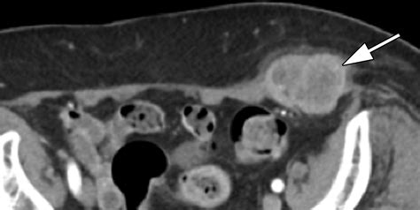 Imaging Of Abdominal Wall Masses Masslike Lesions And Diffuse Processes Radiographics