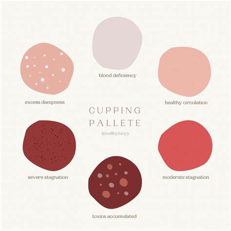 Cupping Therapy Color Chart Cupping Therapy Health And Wellness Sports Therapy