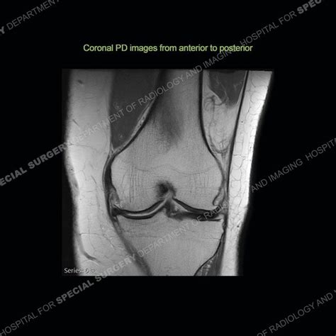 Hss Whats The Diagnosis Case 183 By Hospital For Special Surgery Issuu