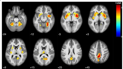 Statistical Parametric Map Showing Brain Regions Positively Correlated