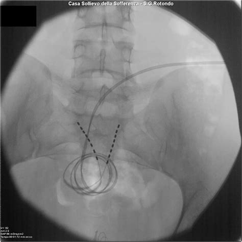 Po246 575 Self Managed Sacral Neuromodulation For The Chronic Urinary Retention Neuromodulation