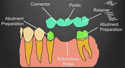 Diagnosis Treatment Planning For Fixed Dental Prostheses Flashcards