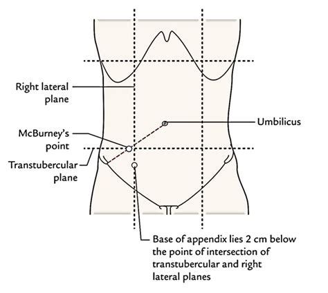 Diagram Showing Location Of Appendix