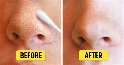 8 Natural Remedies How To Get Rid From Blackheads And Whiteheads