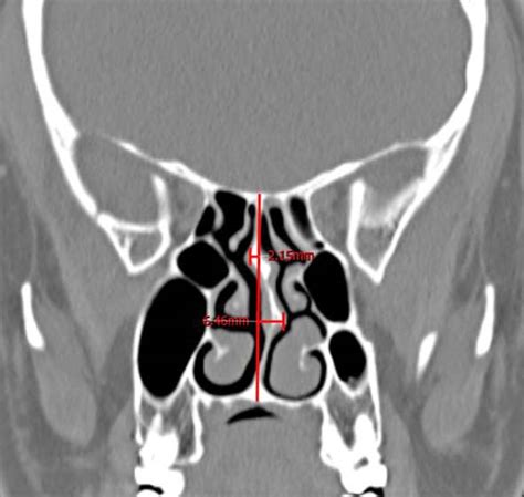 Demographic Clinical Characteristics And Nasal Comorbidities Of