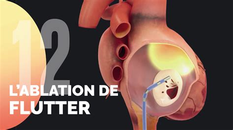 L Ablation De Flutter